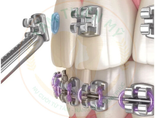 Niềng răng mắc cài kim loại 3m