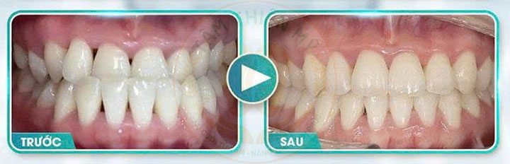 Niềng răng mắc cài kim loại 3m