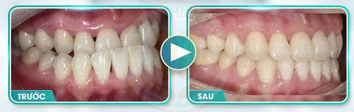 Niềng răng mắc cài kim loại 3m