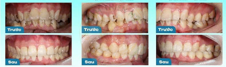 Niềng răng mắc cài kim loại 
