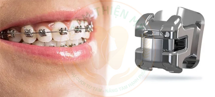 Niềng răng mắc cài kim loại thông minh