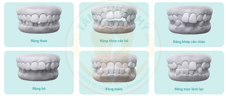 Niềng răng mắc cài kim loại 