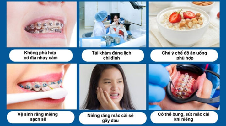 Niềng răng mắc cài kim loại thường giá bao nhiêu? 10 Lưu ý khi niềng răng mắc cài kim loại