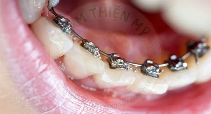 Niềng răng mắc cài kim loại thường giá bao nhiêu? 8 Niềng răng mắc cài kim loại mặt trong