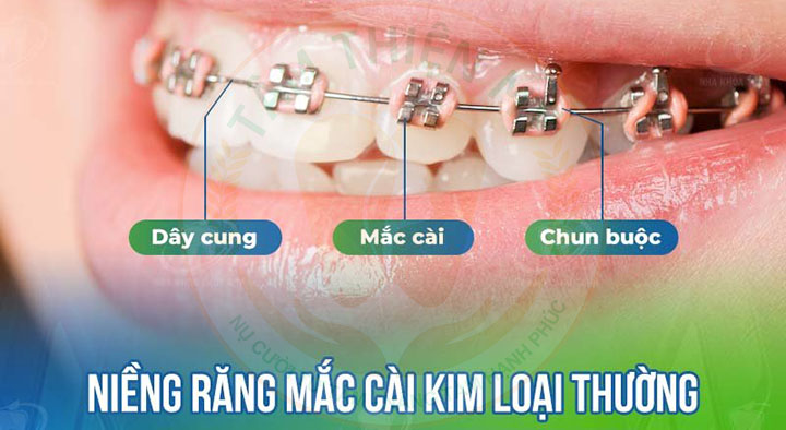 niềng răng mắc cài kim loại