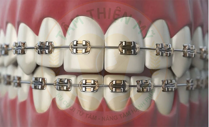 Niềng răng mắc cài kim loại thường giá bao nhiêu? 6 Niềng răng mắc cài kim loại tự buộc