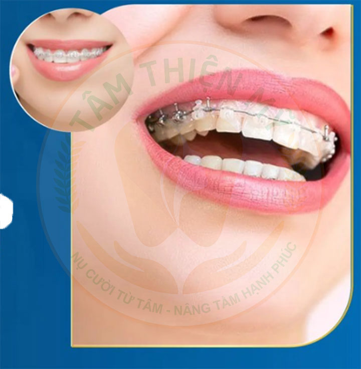 Niềng răng mắc cài sứ có đau không? Giá bao nhiêu? 2 niềng răng mắc cài sứ là gì