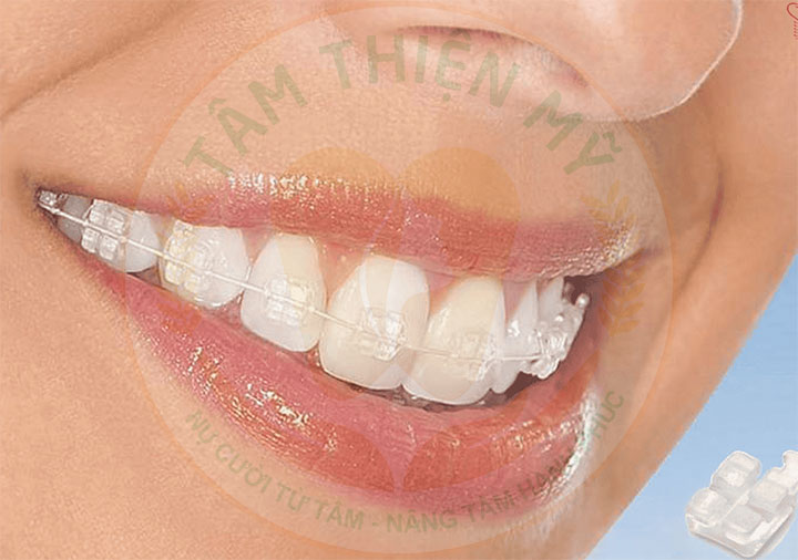 Niềng răng mắc cài sứ có đau không? Giá bao nhiêu? 3 Niềng răng mắc cài sứ có đau không