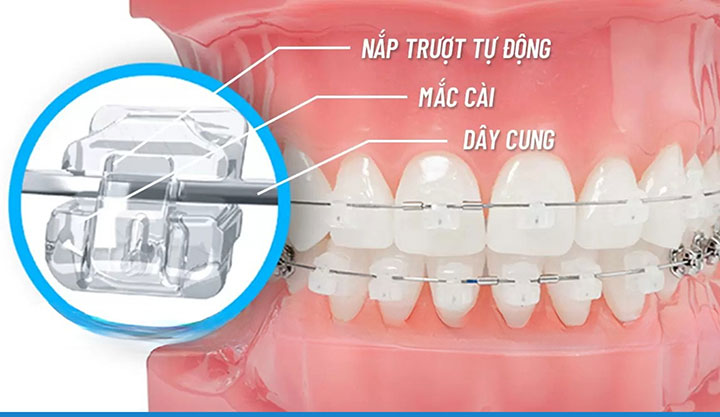 Niềng răng mắc cài sứ có đau không? Giá bao nhiêu? 8 Niềng răng mắc cài sứ tự buộc là gì?