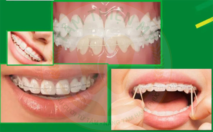 Những kinh nghiệm niềng răng mắc sứ cho các đồng niềng 2 niềng răng mắc cài sứ thường và mắc cài sứ tự buộc