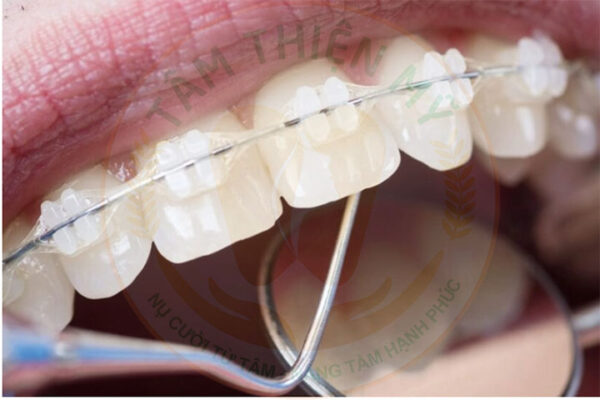 Niềng răng mắc cài sứ tiêu chuẩn