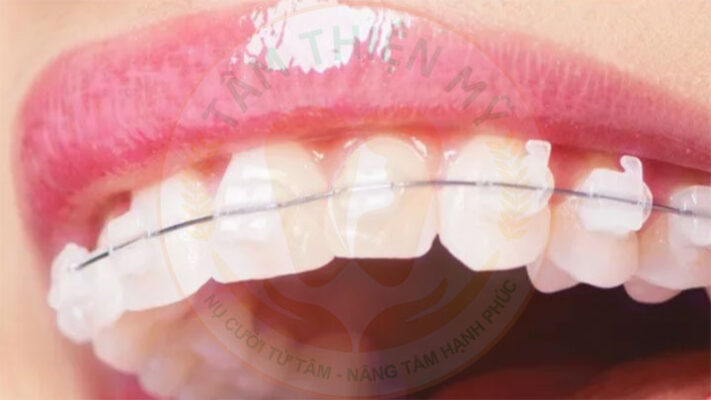 Niềng răng mắc cài sứ tự động