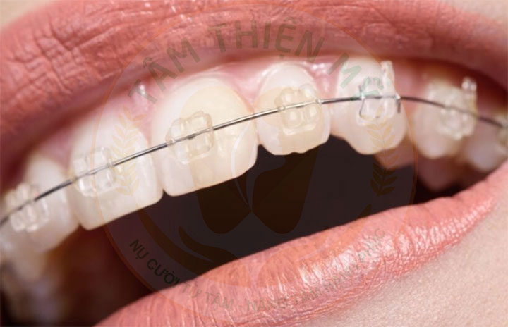 Niềng răng mắc cài sứ có đau không? Giá bao nhiêu? 4 Niềng răng mắc cài sứ tự buộc