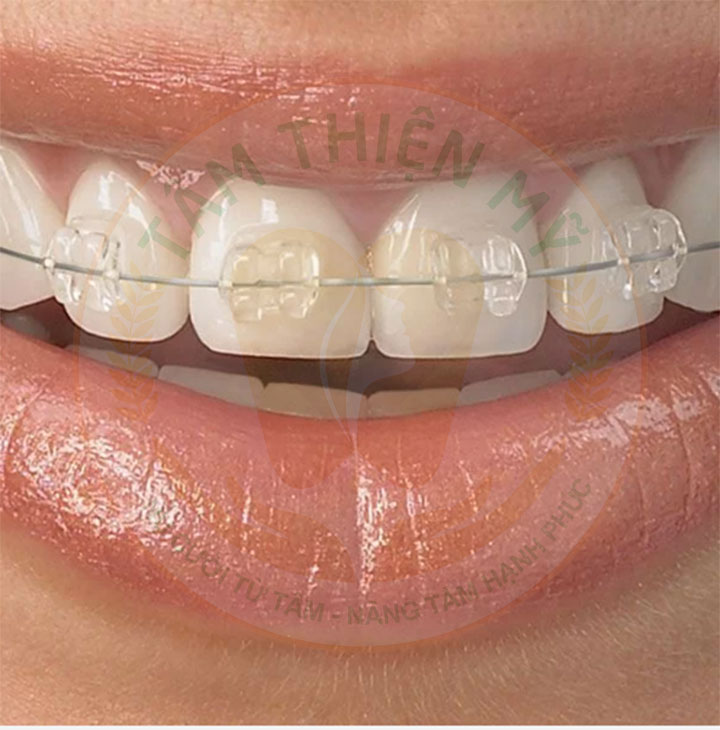 Mắc cài sứ tự buộc là gì? Ưu nhược điểm - chi phí? 8 Niềng răng mắc cài sứ tự buộc giá bao nhiêu?