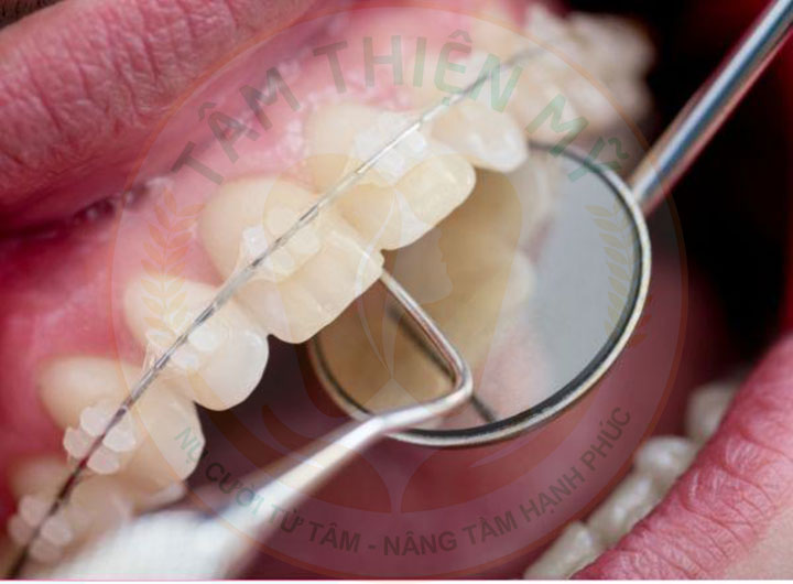 Những kinh nghiệm niềng răng mắc sứ cho các đồng niềng 6 lấy cao răng
