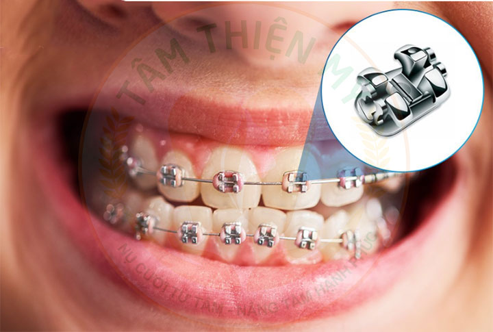Ưu nhược điểm niềng răng mắc cài kim loại tiêu chuẩn 2 niềng răng mắc cài tiêu chuẩn