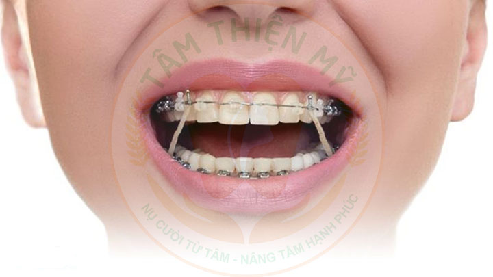 Ưu nhược điểm niềng răng mắc cài kim loại tiêu chuẩn 6 niềng răng mắc cài kim loại tiêu chuẩn