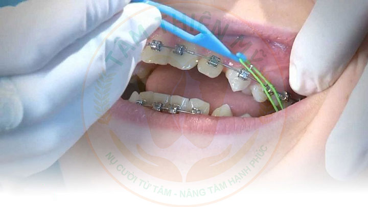 Ưu nhược điểm niềng răng mắc cài kim loại tiêu chuẩn 5 niềng răng mắc cài chun