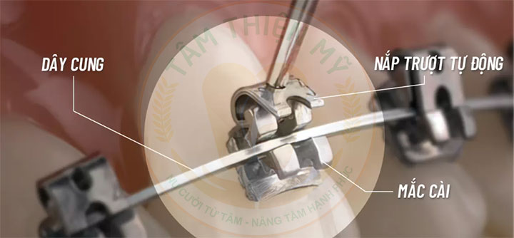 Niềng răng mắc cài kim loại tự động