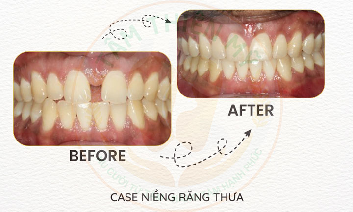 Ưu nhược điểm niềng răng mắc cài kim loại tiêu chuẩn 8 niềng răng thưa