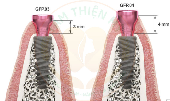 Healing Abutment phân loại
