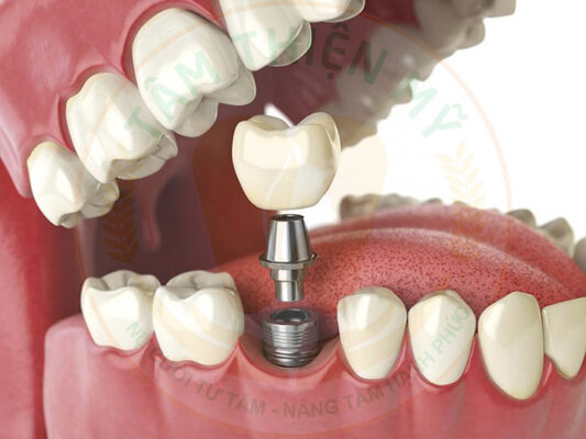 Phục hình răng trên Implant