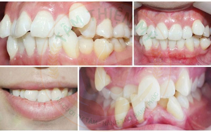 Đối tượng nào phù hợp niềng răng mắc cài kim loại? 4 niềng răng mắc cài kim loại