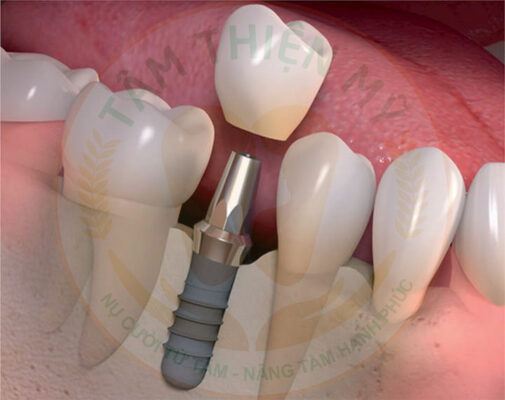 thiết kế mão sứ trên răng Implant