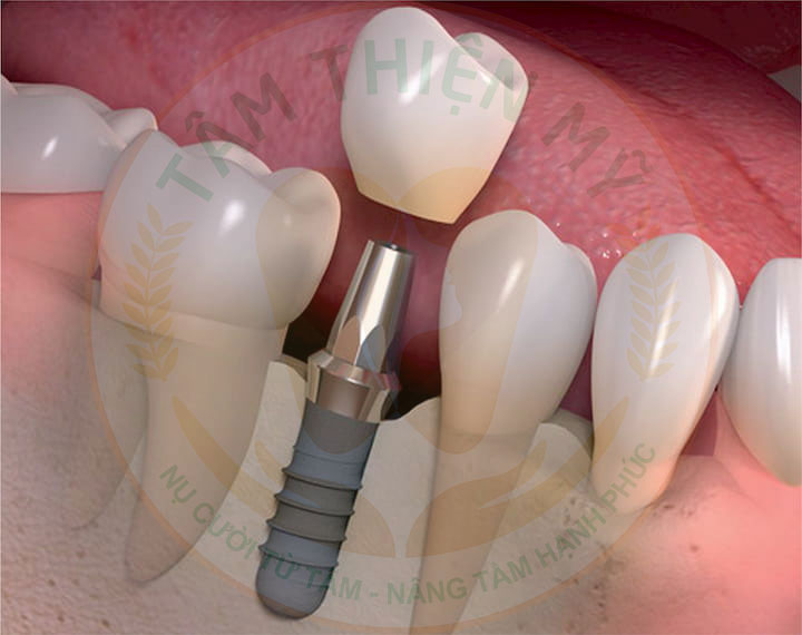 thiết kế mão sứ trên răng Implant