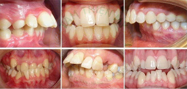 Đối tượng nào phù hợp niềng răng mắc cài kim loại? 3 niềng răng mắc cài kim loại