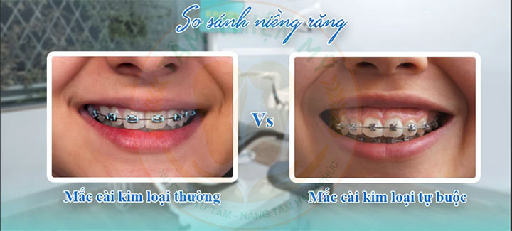 Nên chọn niềng răng mắc cài tự đóng và mắc cài thường? 3 mắc cài tự buộc và mắc cài thường