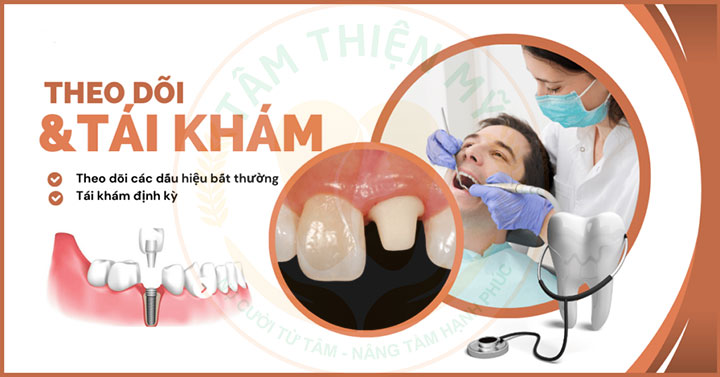 Hướng dẫn chế độ chăm sóc răng Implant được bền đẹp trọn đời 7 chăm sóc răng implant