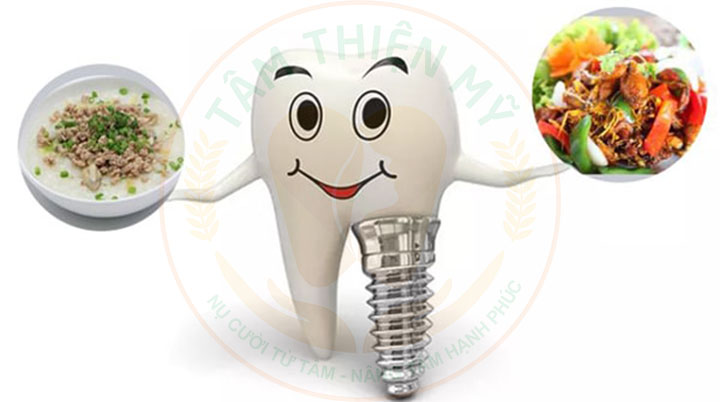 Hướng dẫn chế độ chăm sóc răng Implant được bền đẹp trọn đời 3 chăm sóc răng implant