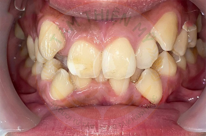 Ưu nhược điểm niềng răng mắc cài kim loại tiêu chuẩn 9 niềng răng mắc cài kim loại truyền thống
