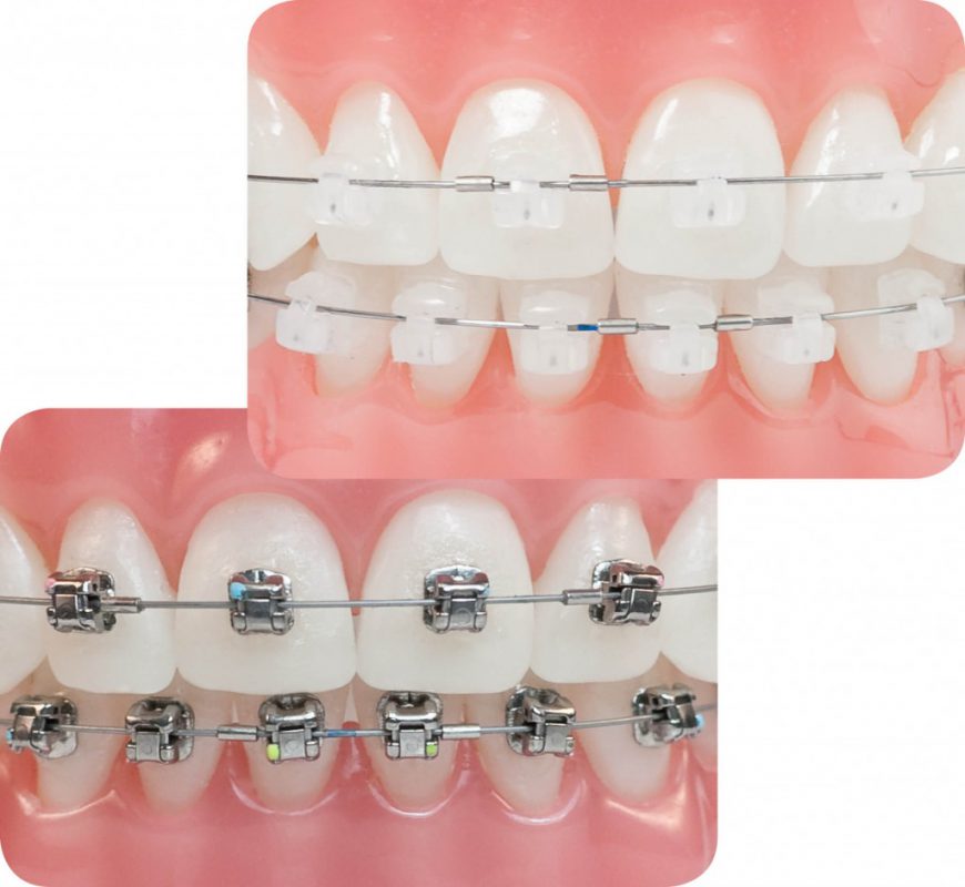 Niềng răng mắc cài tự động giá bao nhiêu? 2 Niềng răng mắc cài tự động tự buộc/ tự đóng