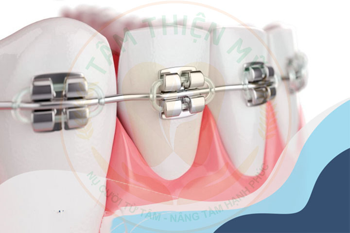 Niềng răng mắc cài kim loại thường giá bao nhiêu? 4 ưu điểm