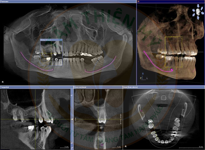 Máy CT Cone Beam 3D - Bước đầu quyết định 1 ca Implant thành công 8 chuẩn đoán bệnh lý