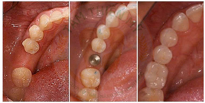 Kỹ thuật cấy ghép răng Implant tại Tâm Thiện Mỹ có gì HOT? 7 lợi ích cấy ghép implant