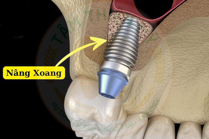 Nâng xoang trong cấy ghép Implant - Giải pháp phục hồi xương hàm hiệu quả 10 Nâng xoang trong cấy ghép Implant