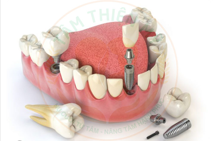 Hỗ trợ phục hình trên Implant