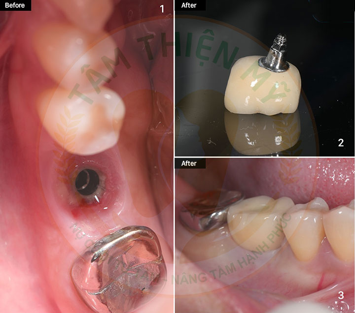 Implant xương bướm - phục hình không ghép xương, nâng xoang 9 phục hình răng implant xương bướm