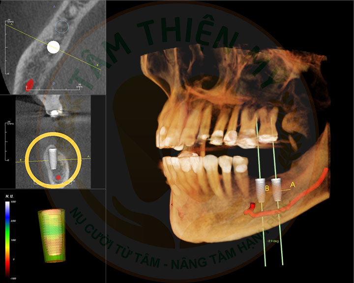 Máy CT Cone Beam 3D - Bước đầu quyết định 1 ca Implant thành công 4 cấy ghép implant