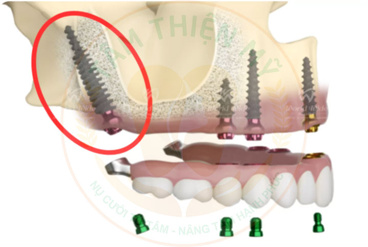 Implant xương bướm - phục hình không ghép xương, nâng xoang 4 Implant xương bướm