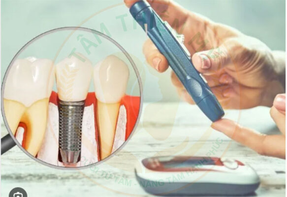 Giải pháp cấy ghép Implant cho bệnh nhân có bệnh nền tại Tâm Thiện Mỹ