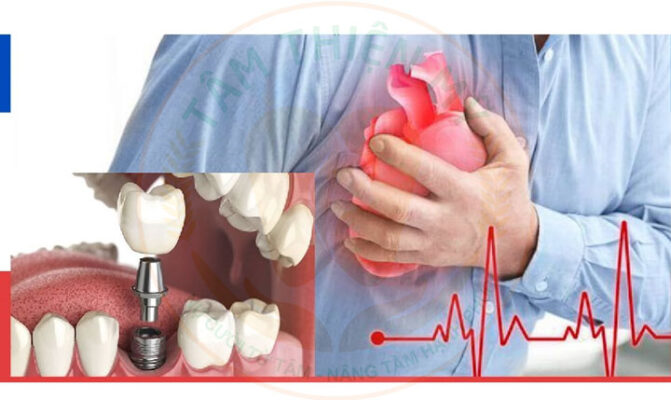 Giải pháp cấy ghép Implant cho bệnh nhân có bệnh nền tại Tâm Thiện Mỹ