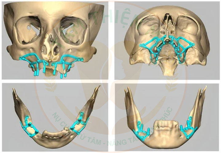 cấy ghép Implant dưới màng xương