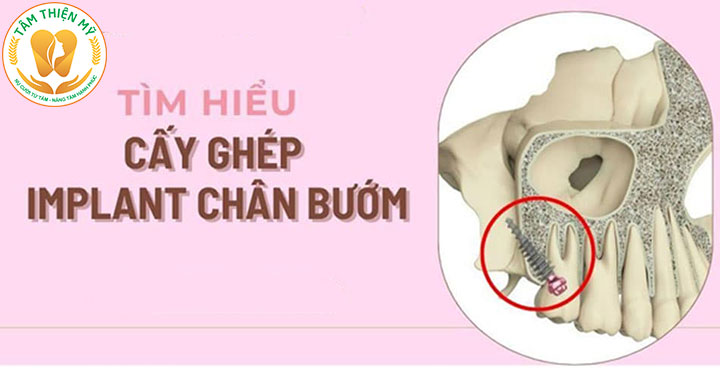 Implant xương bướm