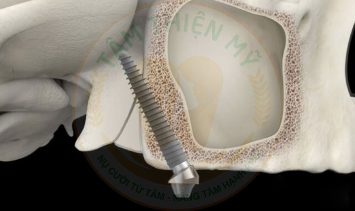 Implant xương bướm - phục hình không ghép xương, nâng xoang 3 Lợi ích của Implant xương bướm