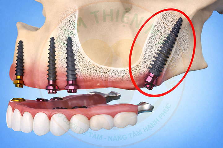 Implant xương bướm - phục hình không ghép xương, nâng xoang 7 cấy ghép Implant xương bướm