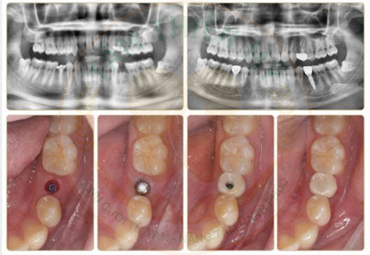 Kỹ thuật cấy ghép răng Implant tại Tâm Thiện Mỹ có gì HOT? 8 Kỹ thuật cấy ghép răng Implant tại Tâm Thiện Mỹ